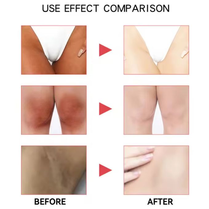 Sensitive parts whitening cream